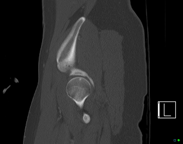 Bilateral acetabular fractures (Radiopaedia 79272-92308 Sagittal bone window 15).jpg