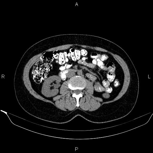 Bilateral adrenal myelolipoma (Radiopaedia 63058-71535 Axial non-contrast 86).jpg