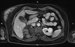 Bilateral adrenal myelolipoma (Radiopaedia 63058-71537 G 37).jpg