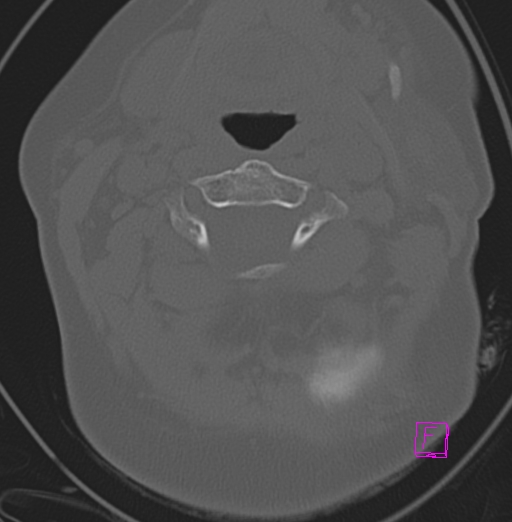 File:Bilateral atlanto-occipital assimilation (Radiopaedia 28350-28603 Axial bone window 14).jpg