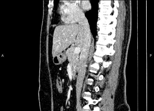 Bilateral benign adrenal adenomas (Radiopaedia 86912-103124 E 45).jpg