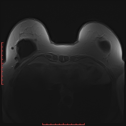 File:Bilateral breast implant rupture (Radiopaedia 24761-25027 PASTA 24).jpg