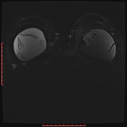 File:Bilateral breast implant rupture (Radiopaedia 24761-25027 PASTA Si IR 17).jpg