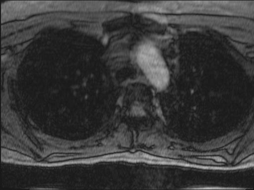Bilateral carotid body tumors and right glomus jugulare tumor (Radiopaedia 20024-20060 Axial MRA 151).jpg