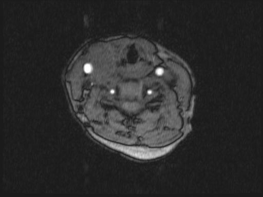 Bilateral carotid body tumors and right glomus jugulare tumor (Radiopaedia 20024-20060 Axial MRA 237).jpg