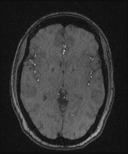 Bilateral carotid body tumors and right glomus jugulare tumor (Radiopaedia 20024-20060 Axial MRA 93).jpg