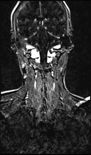 Bilateral carotid body tumors and right glomus jugulare tumor (Radiopaedia 20024-20060 MRA 126).jpg