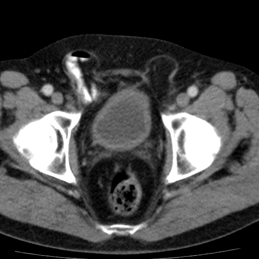 File:Bilateral direct inguinal herniae (Radiopaedia 17016-16719 B 17).jpg