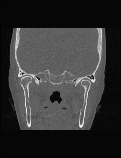 Bilateral frontal mucoceles (Radiopaedia 82352-96454 Coronal 273).jpg