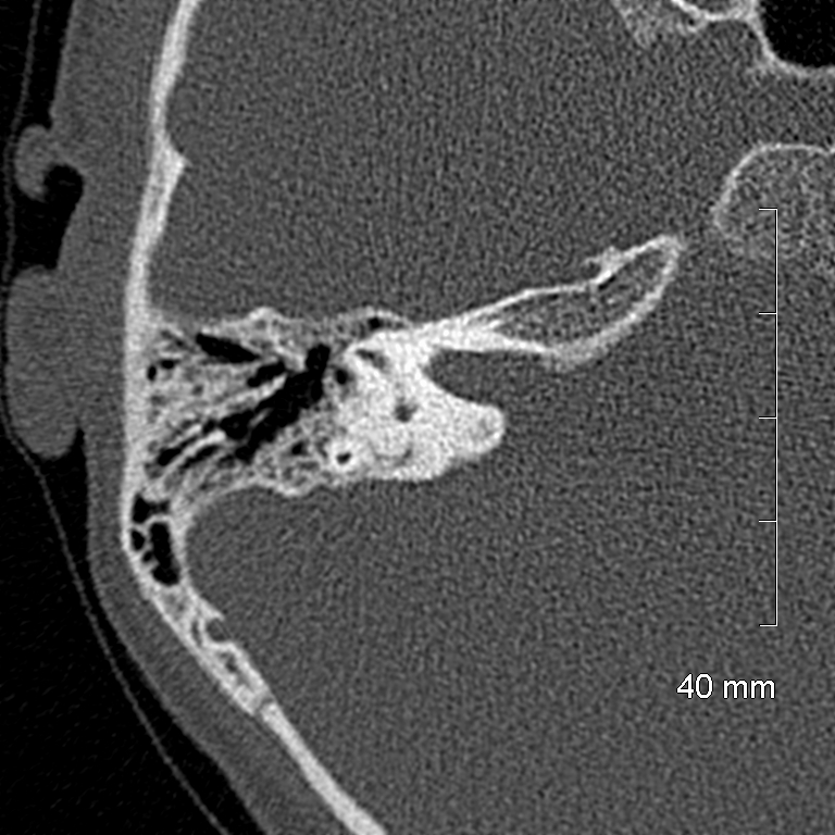 Bilateral grommets (Radiopaedia 47710-52404 Axial bone window 47).jpg