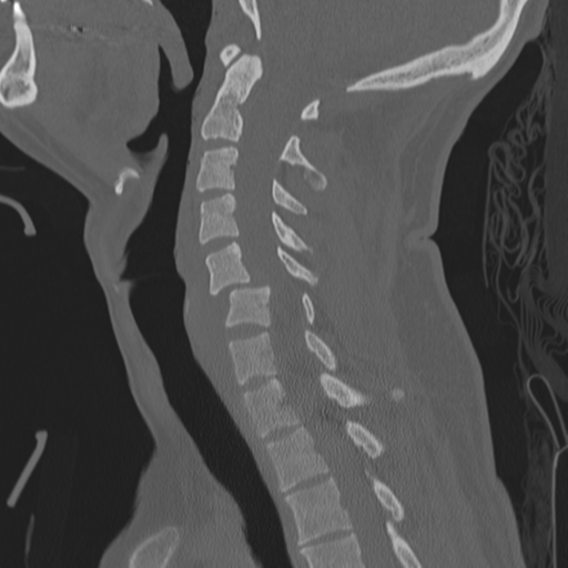 Bilateral locked facets (Radiopaedia 33850-35016 Sagittal bone window 22).png