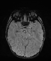 File:Bilateral mesial temporal polymicrogyria (Radiopaedia 76456-88181 Axial SWI 25).jpg