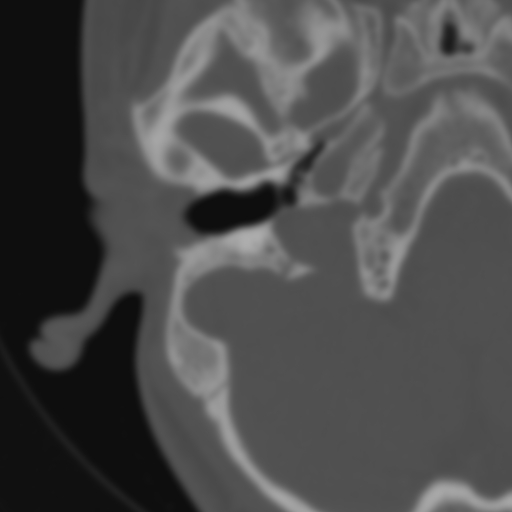 File:Bilateral otosclerosis (Radiopaedia 57237-64157 B 39).jpg