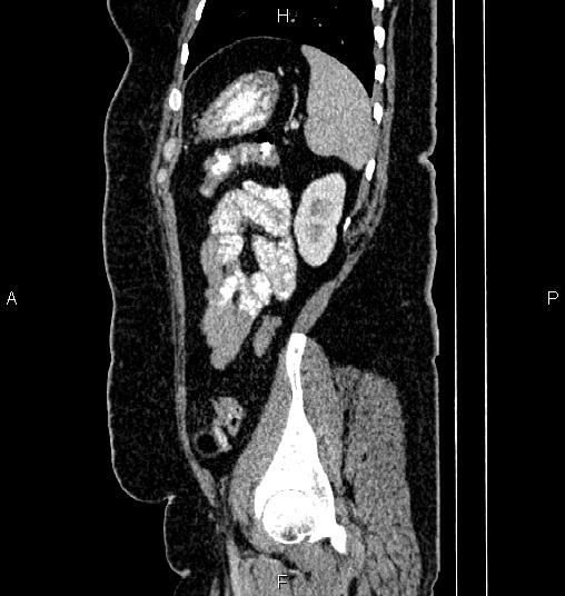 File:Bilateral ovarian dermoid cysts (Radiopaedia 85785-101603 D 76).jpg