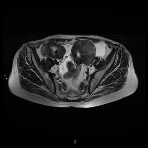 File:Bilateral ovarian fibroma (Radiopaedia 44568-48293 Axial T2 10).jpg