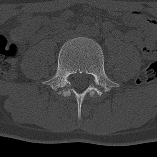 File:Bilateral pars defect (Radiopaedia 26691-26846 Axial bone window 27).jpg