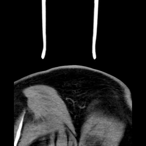 File:Bilateral peritonsillar abscess (Radiopaedia 85065-100610 Coronal 77).jpg
