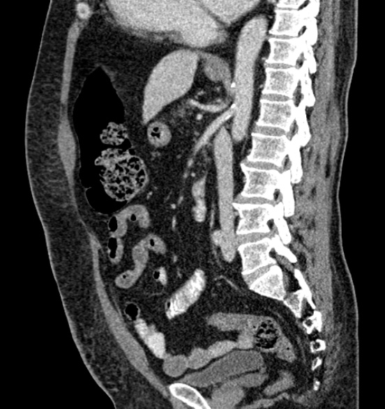 Bilateral rectus sheath hematomas (Radiopaedia 50778-56252 B 45).jpg