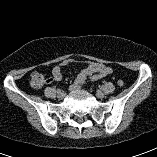 Bilateral staghorn calculi (Radiopaedia 59475-66842 Axial non-contrast 57).jpg