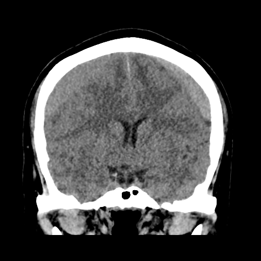 Bilateral subacute subdural hematoma (Radiopaedia 69240-79018 Coronal non-contrast 25).jpg