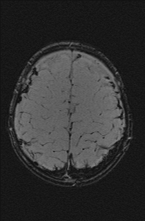 File:Bilateral subdural hemorrhage and parietal skull fracture (Radiopaedia 26058-26190 Axial SWI 66).png