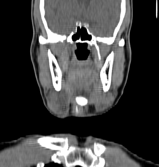 Bilateral submandibular sialolithiasis with sialadenitis (Radiopaedia 70721-80881 Coronal non-contrast 27).jpg