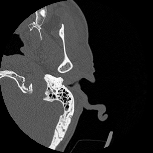 File:Bilateral temporal bone fractures (Radiopaedia 29482-29970 D 24).jpg