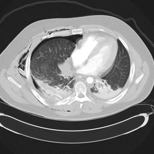 Bilateral traumatic renovascular injury (Radiopaedia 32051-32995 Axial lung window 32).jpg