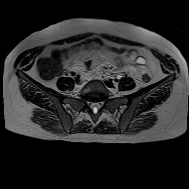 Bilateral tubo-ovarian abscesses (Radiopaedia 58635-65829 Axial T2 4).jpg