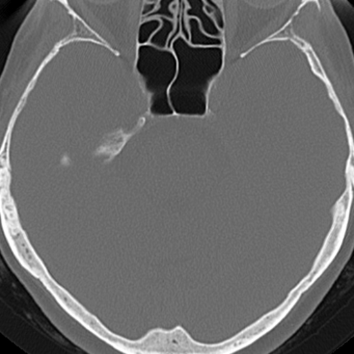 File:Bilateral tympanoplasty (Radiopaedia 16947-16664 Axial bone window 2).jpg