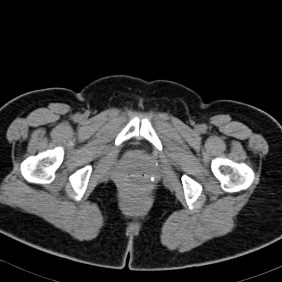 File:Bilateral ureteric stents (Radiopaedia 48795-53825 Axial non-contrast 71).jpg