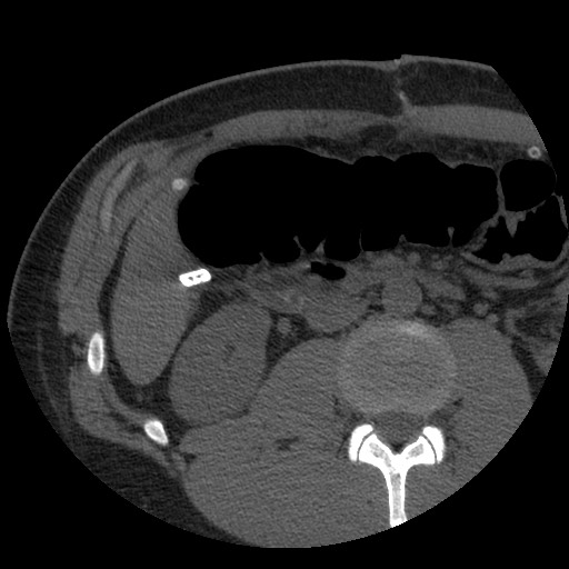File:Bile leak from liver traumatic laceration (Radiopaedia 63463-72077 Axial Biliscopin 71).jpg