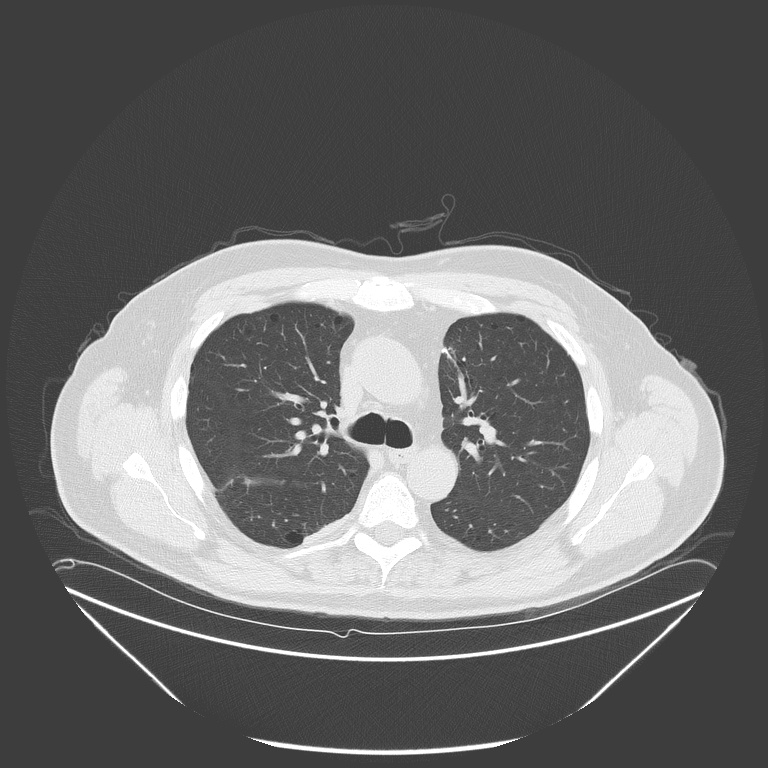 Birt-Hogg-Dubé syndrome (Radiopaedia 52578-58491 Axial lung window 21).jpg