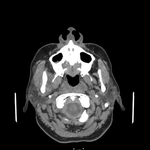 Bisphosphonate-related osteonecrosis of the jaw (Radiopaedia 71324-81642 non-contrast 120).jpg