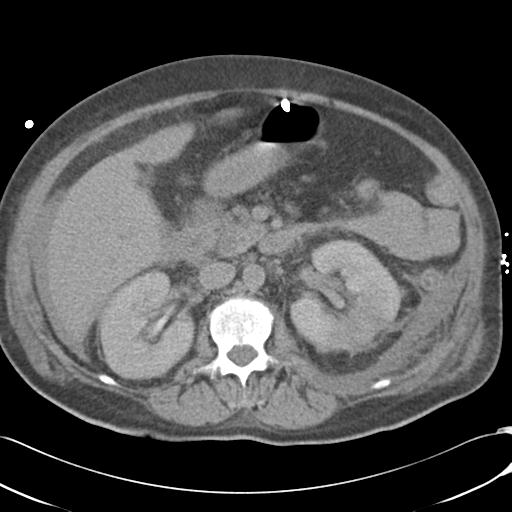 Bladder rupture post renal biopsy (Radiopaedia 30863-31572 Axial non-contrast 36).jpg