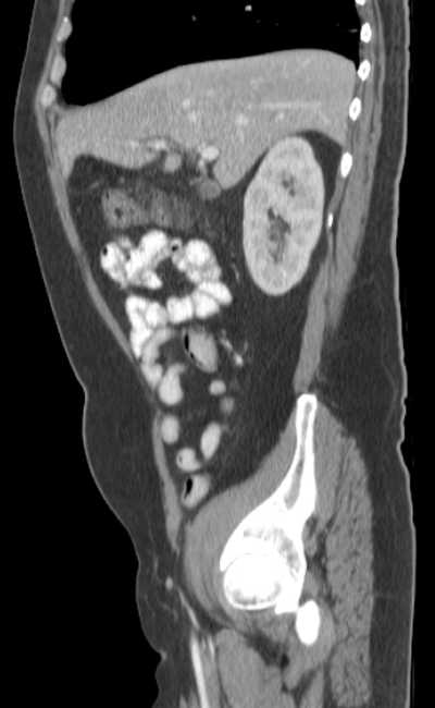 Bleeding duodenal ulcer and adenomyomatosis of gallbladder (Radiopaedia 61834-69861 C 28).jpg