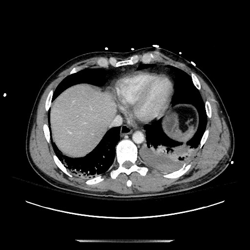 Blunt abdominal trauma with solid organ and musculoskelatal injury with active extravasation (Radiopaedia 68364-77895 A 11).jpg