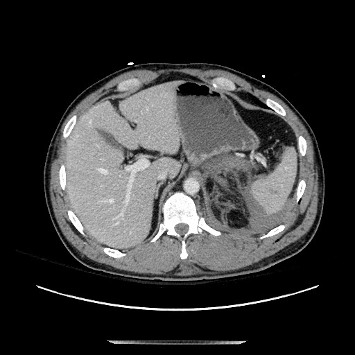 Blunt abdominal trauma with solid organ and musculoskelatal injury with active extravasation (Radiopaedia 68364-77895 A 30).jpg