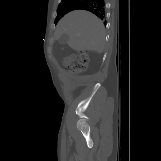 Blunt abdominal trauma with solid organ and musculoskelatal injury with active extravasation (Radiopaedia 68364-77895 Sagittal bone window 12).jpg