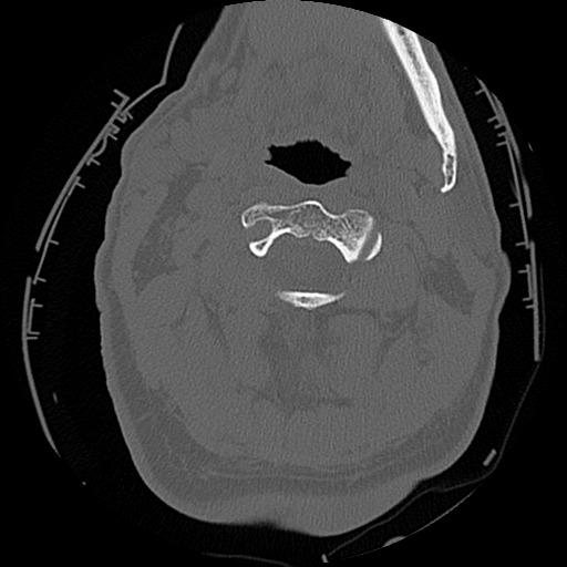 File:Blunt cerebrovascular injury (Radiopaedia 53682-59743 Axial bone window 19).png