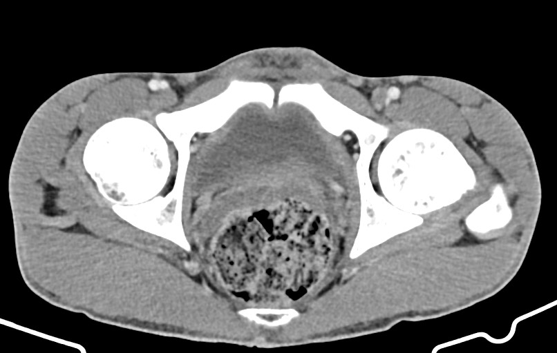 Blunt injury to the small bowel (Radiopaedia 74953-85987 A 186).jpg