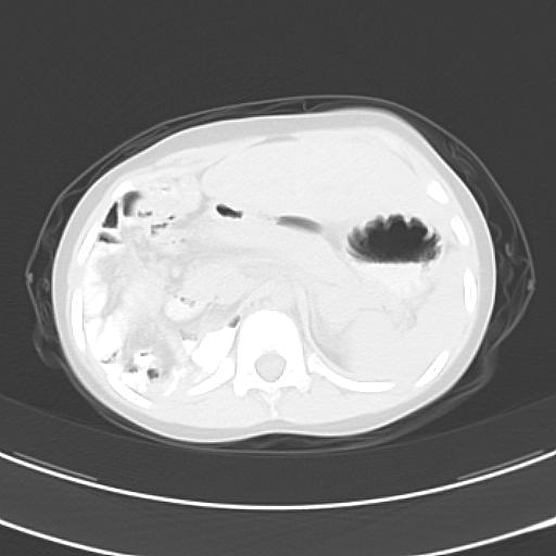 File:Bochdalek diaphragmatic hernia (Radiopaedia 38866-41059 Axial lung window 25).jpg