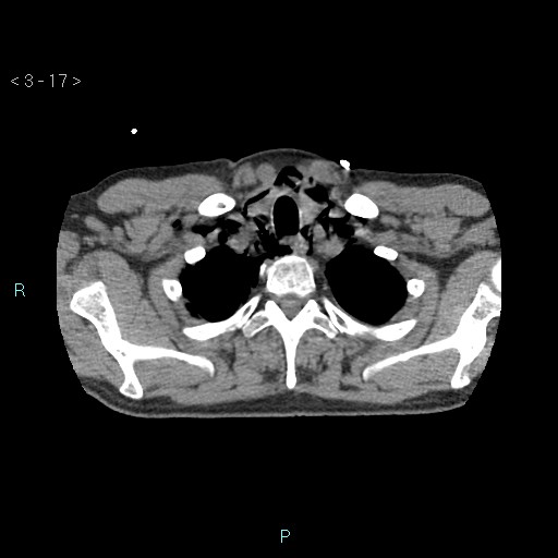 Boerhaave syndrome (Radiopaedia 27683-27897 oral contrast 17).jpg