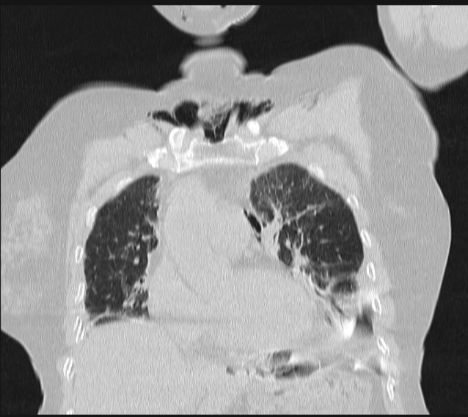 Boerhaave syndrome (Radiopaedia 45644-49799 Coronal lung window 23).jpg