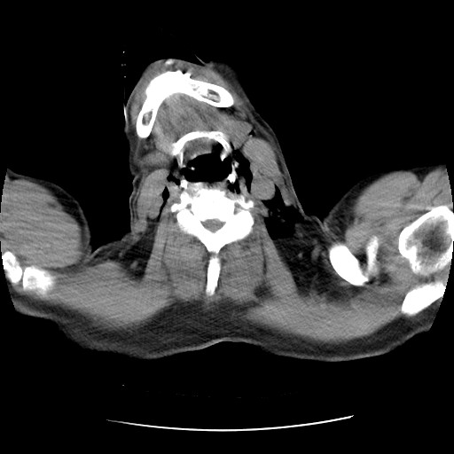 Boerhaave syndrome (Radiopaedia 59796-67310 Axial liver window 1).jpg