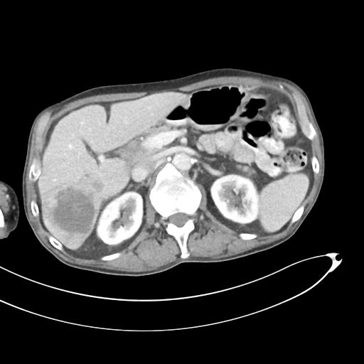 Bone metastasis from squamous cell carcinoma (Radiopaedia 30133-30730 B 24).jpg