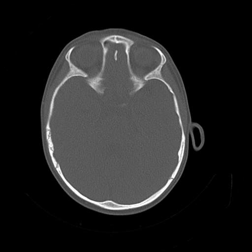 File:Bony atresia of the right external auditory canal (Radiopaedia 27916-28156 Axial bone window 14).jpg