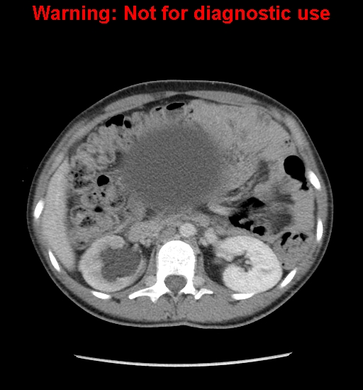 Borderline mucinous cystadenoma of ovary (Radiopaedia 25586-25767 A 5).jpg