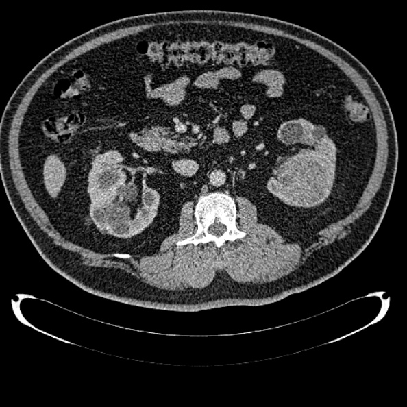Bosniak renal cyst - type IV (Radiopaedia 24244-24518 C 155).jpg