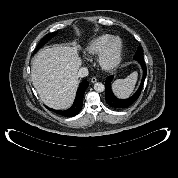 File:Bosniak renal cyst - type IV (Radiopaedia 24244-24518 C 21).jpg